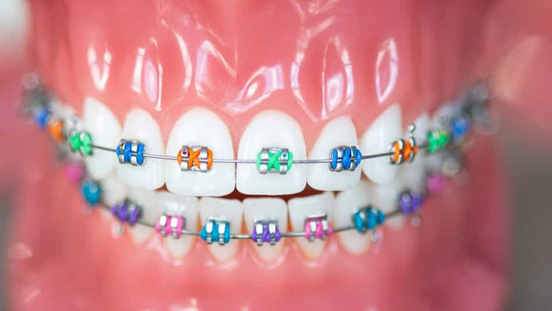What Are The Popular Braces Color Combinations And Ideas?
