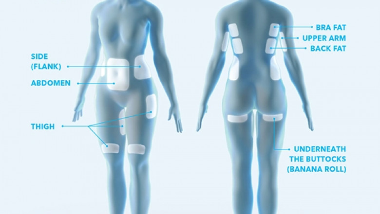 One Of The Best Clinic For Coolsculpting In South Carolina