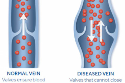 Varicose Vein