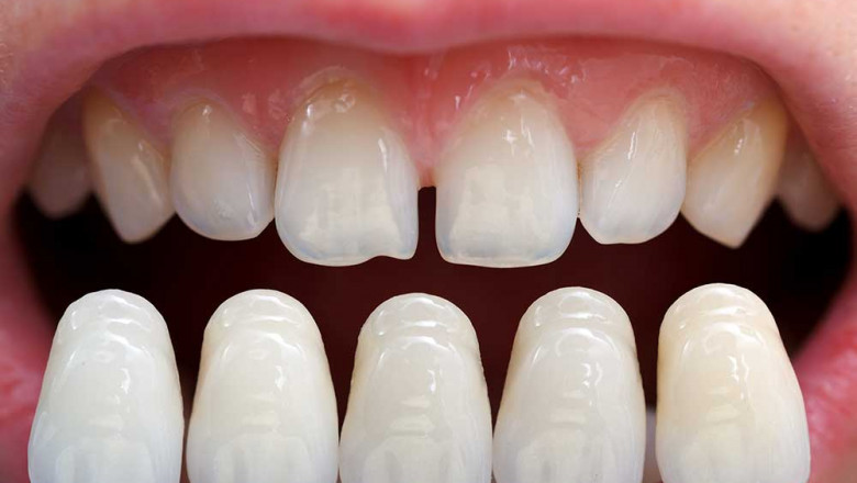 Can veneers stain?