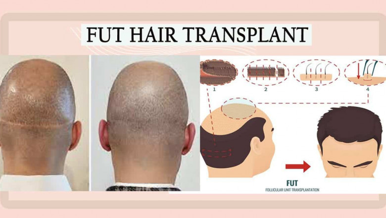 Facts to know about Follicular Unit Transplantation (FUT) in Hair Restoration Surgery