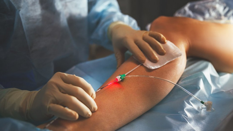 Is Varicose Vein treatment Necessary?