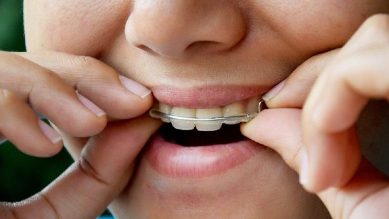 What Do You Expect During A Root Canal?