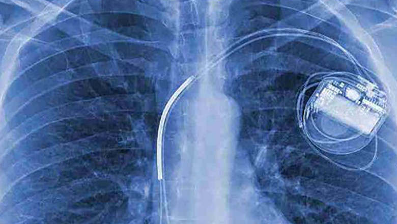 An Active Implantable Medical Devices Are Placed Wholly Or Partially Into The Body Through Surgery In A Natural Opening