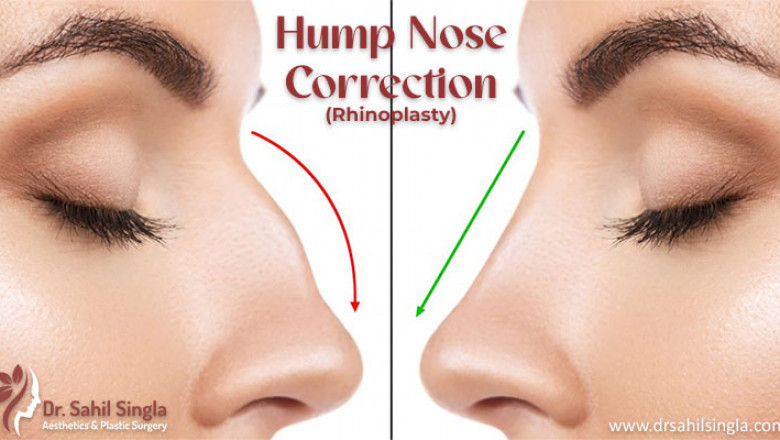 Hump Nose: Causes, Treatment, and Recovery