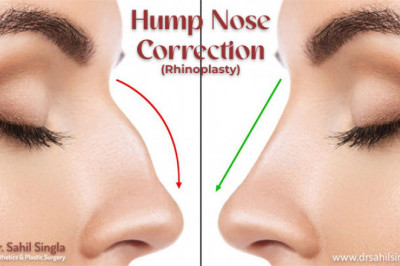 Hump Nose: Causes, Treatment, and Recovery