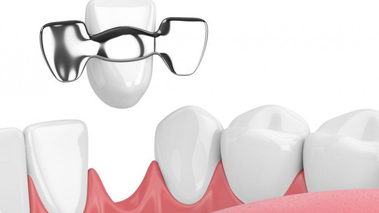 What Is the Most Used Type of Dental Implant?