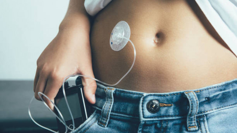 United States Insulin Pumps Market Share, Size, Outlook, Key Players and Growth and Forecast 2026