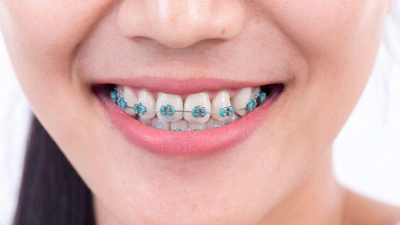 Why Do Dentists Use Power Chains In Braces?