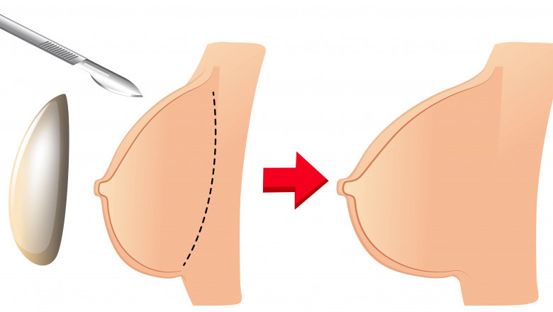 Breast augmentation surgery - Enhance your beauty and self-confidence