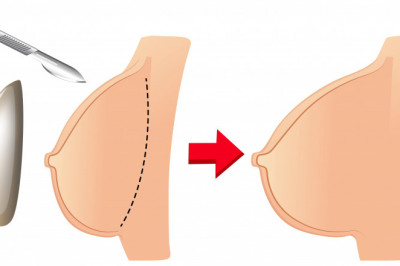 Breast augmentation surgery - Enhance your beauty and self-confidence