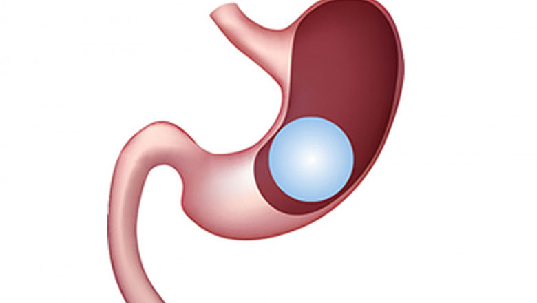 Mini Gastric Bypass Surgery at Indore-Laparoscopy-Center