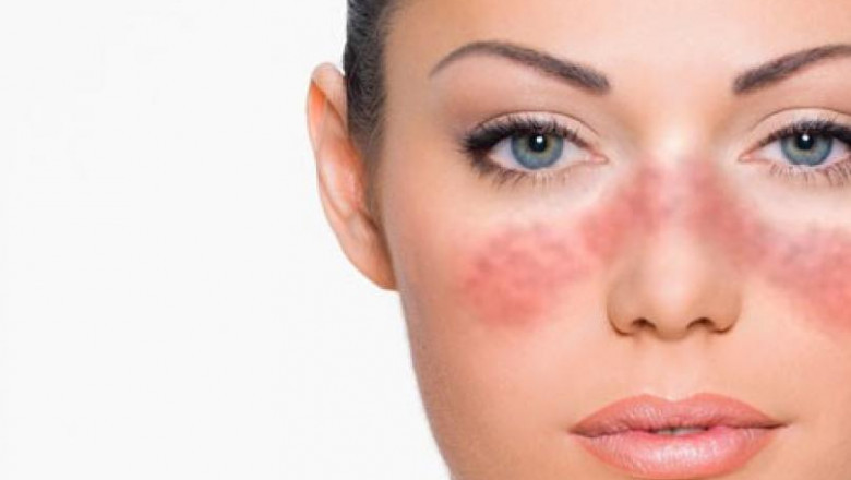 Systemic Lupus Erythematosus Treatment Market outlook