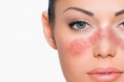 Systemic Lupus Erythematosus Treatment Market outlook