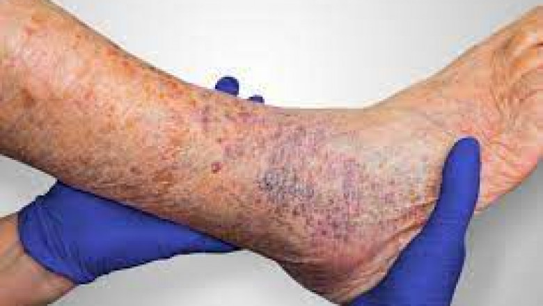 What Are The Symptoms Of A Leg Ulcer?