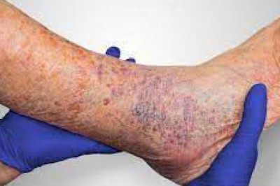 What Are The Symptoms Of A Leg Ulcer?