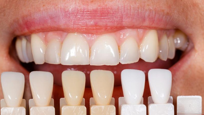 Veneers for Stained Teeth