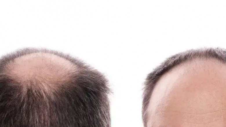 How you can stop hairline receding | AHS UAE