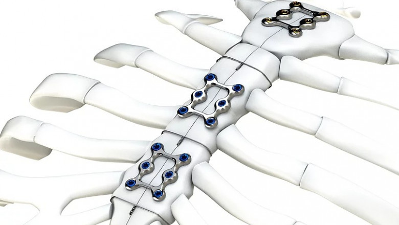 Global Sternal Closure Systems Market Latest Trends, Demand and Advancement 2022 to 2028