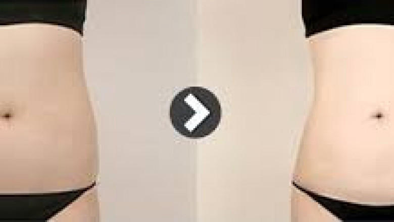 Body Contouring Before and After Pictures Seoul South Korea - Liposuctionkorea