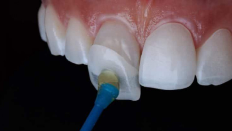 How To Fix Your Crooked Yellow Teeth Instantly?