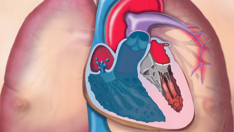 Symptoms of Pulmonary Arterial Hypertension
