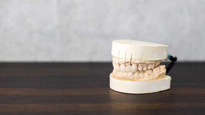 What Should We Know About Dental Veneer Treatment?