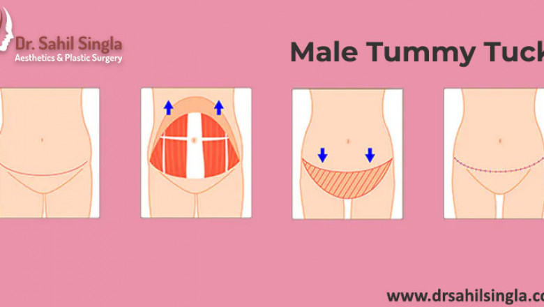 Men's Tummy Tuck: what you can expect?