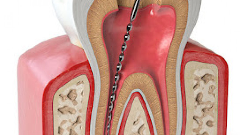 Dental Veneers In Sacramento - Veneer Services