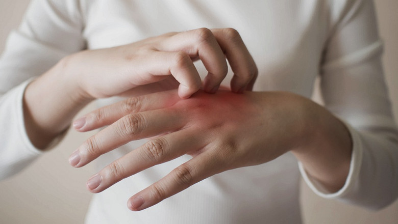 Eczema Therapeutics Market Research Report Detailed Analysis 2022