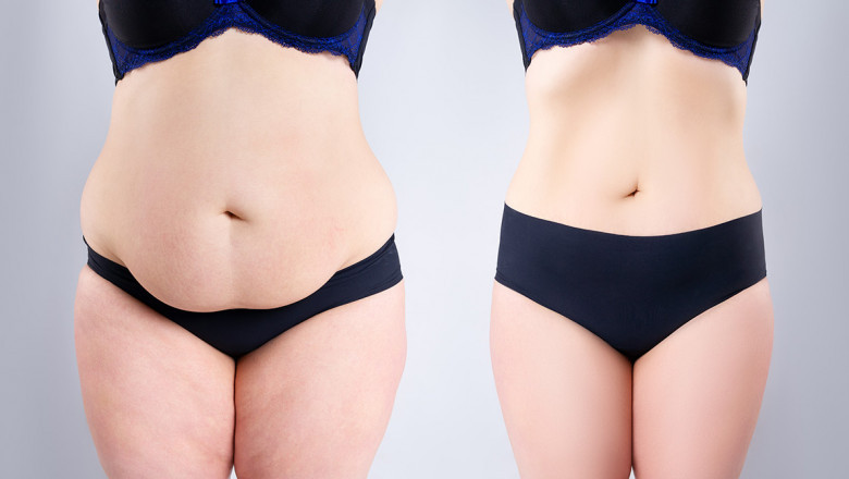 What Is A Tummy Tuck?