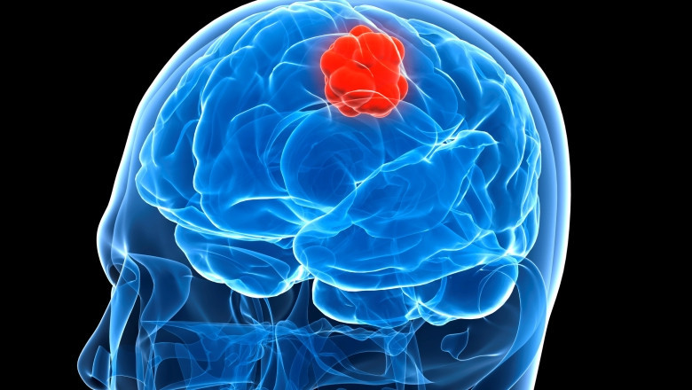 Glioblastoma Multiforme Treatment Market Deep Analysis, Forecast period 2022-2027