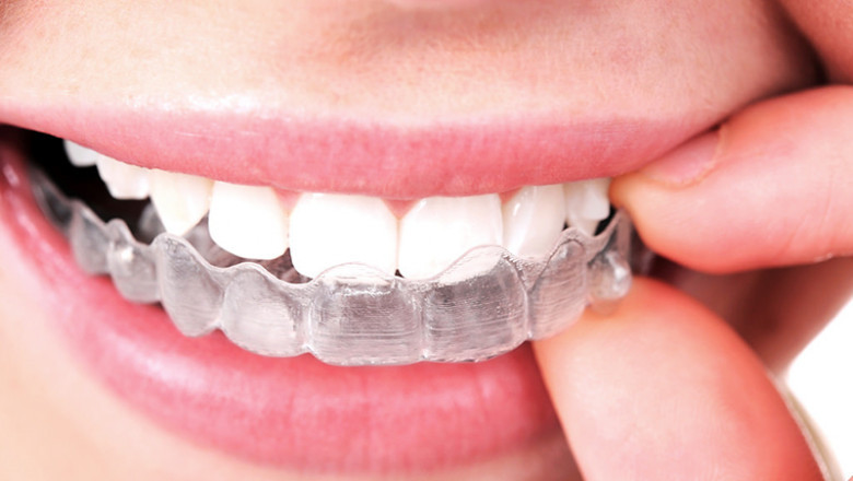 How Does The Invisalign Procedure Work?