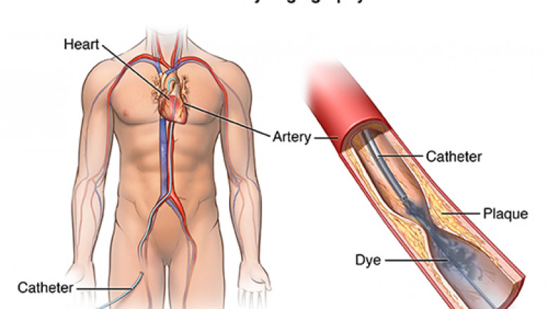 Angiography in Pimpri Chinchwad | Best Cardiologist in PCMC | Dr. Kartik Bhosale