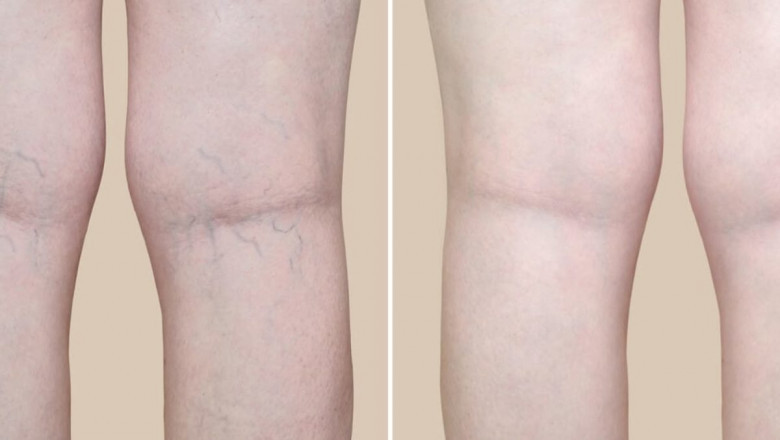 When to See a Veins Specialist?