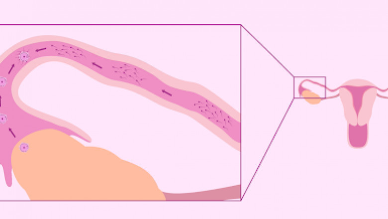Female Infertility Caused by the Blocked Fallopian Tubes – What to Know