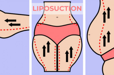 Liposuction, everything you need to know