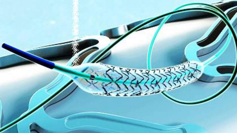 The Global Neurovascular Devices Market is Classified by Product, Disease Pathology, and Region