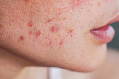 How do I avoid acne scars? Can treatment remove acne scars permanently?