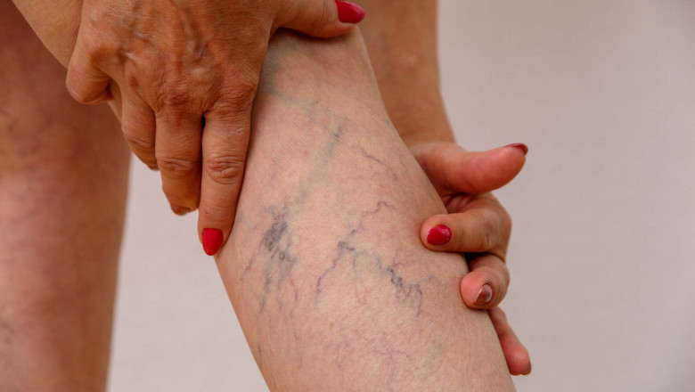 Who is a Vein Doctor?