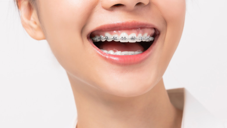 How To Correct An Underbite Without Surgery?