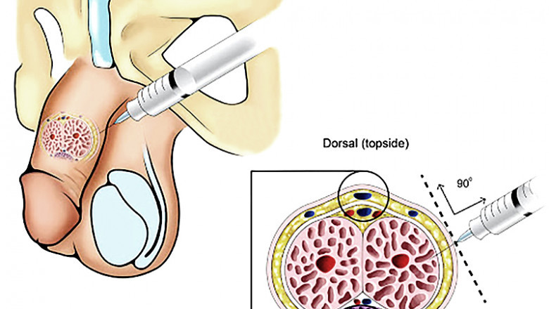 Must-know benefits of p-shots for stronger erection in Kuala Lumpur