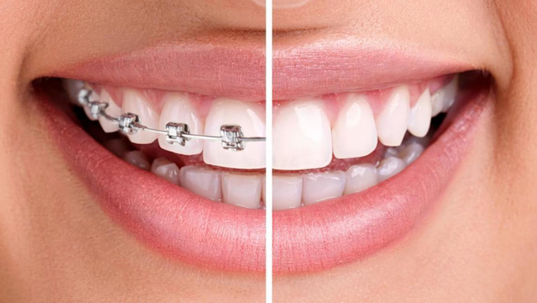 What Are Vital Facts About Dental Bonding?