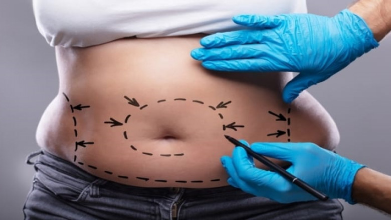 Abdominoplasty: know the risks in the postoperative period