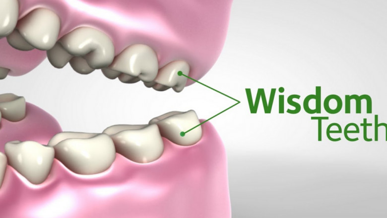 What is Wisdom Teeth and How Do I Know if I Have Wisdom Teeth?