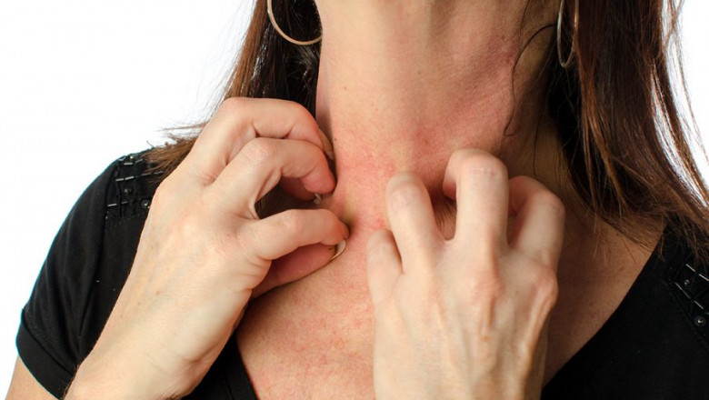 Do not scratch! It will make eczema worse