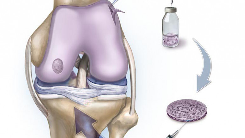 Autologous Matrix-Induced Chondrogenesis Market Grows As The Demand For Collagen Membranes Operations Are Increasing