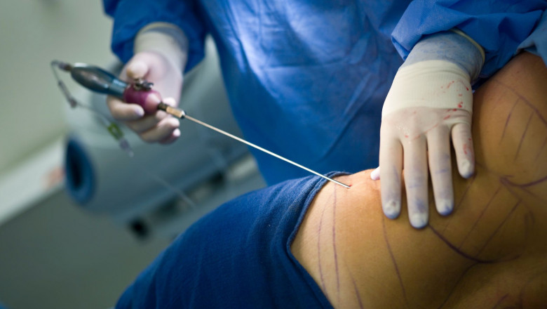 Why Not To Have A Traditional Liposuction