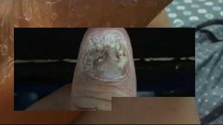 Onychomycosis ointment penetrate into the nails