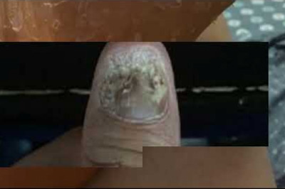 Onychomycosis ointment penetrate into the nails